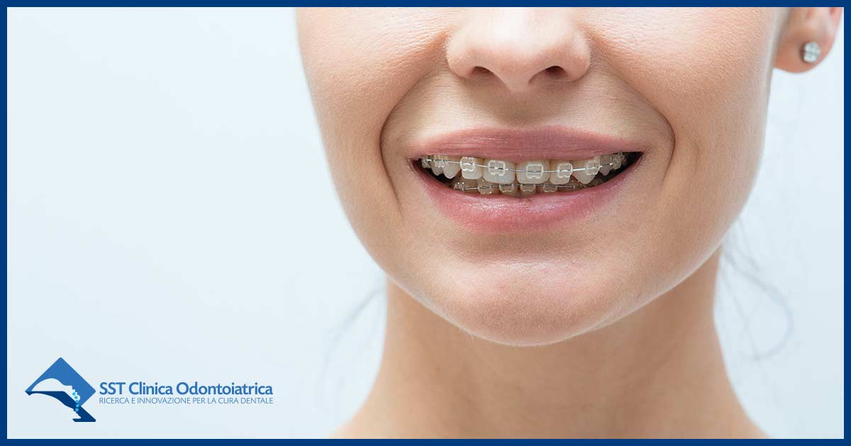 malocclusione trattamento adulti
